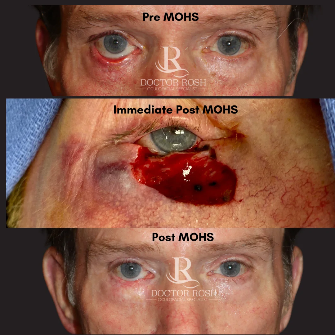 MOHS reconstruction before and after - Pre MOHS, Immediate Post MOHS, and Post MOHS