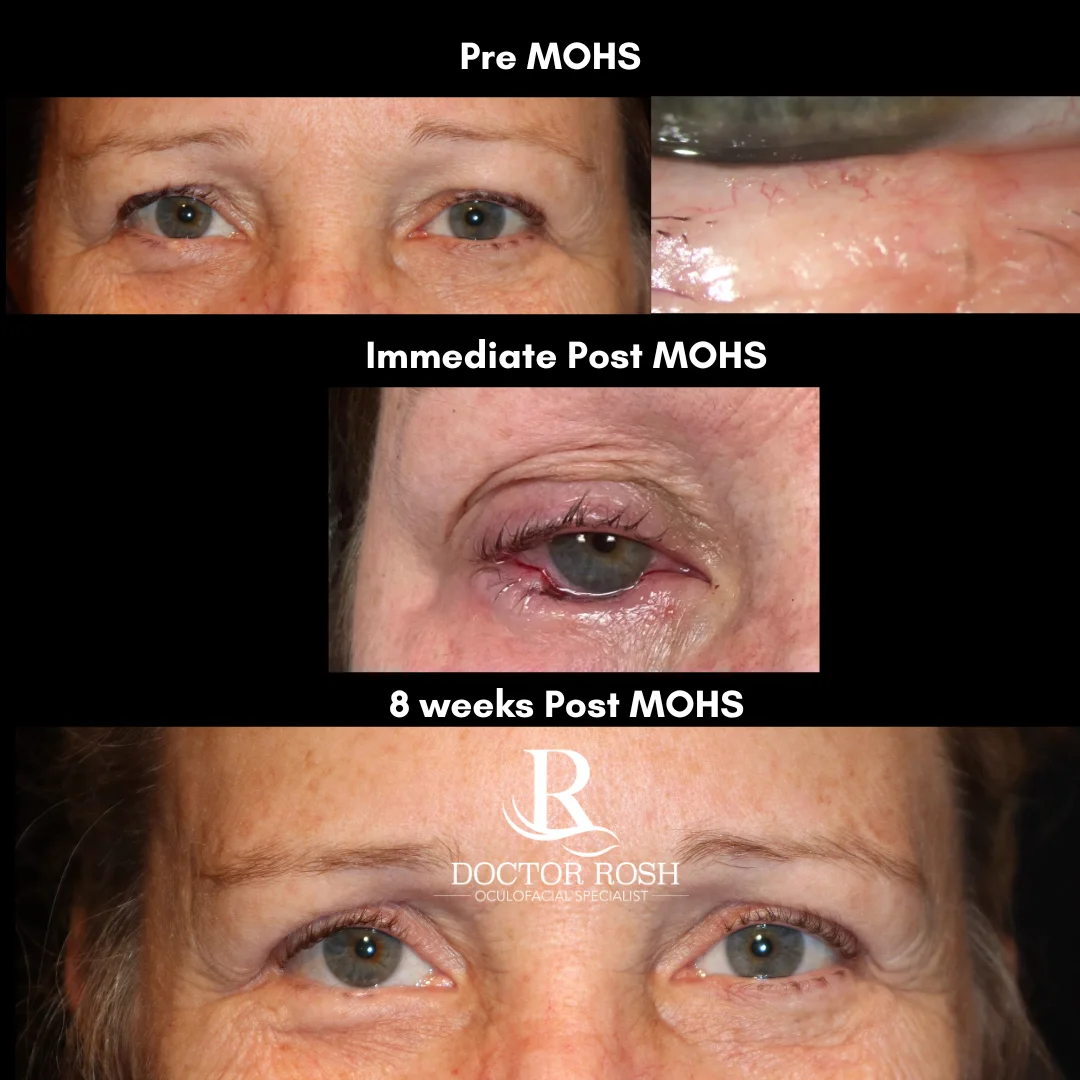 MOHS reconstruction before and after - Richards: Pre MOHS, Immediate Post MOHS, and 8 weeks Post MOHS
