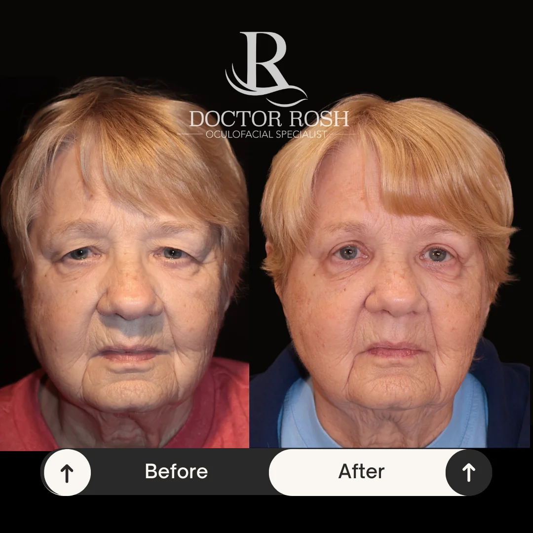 Upper blepharoplasty before and after - Gail full face