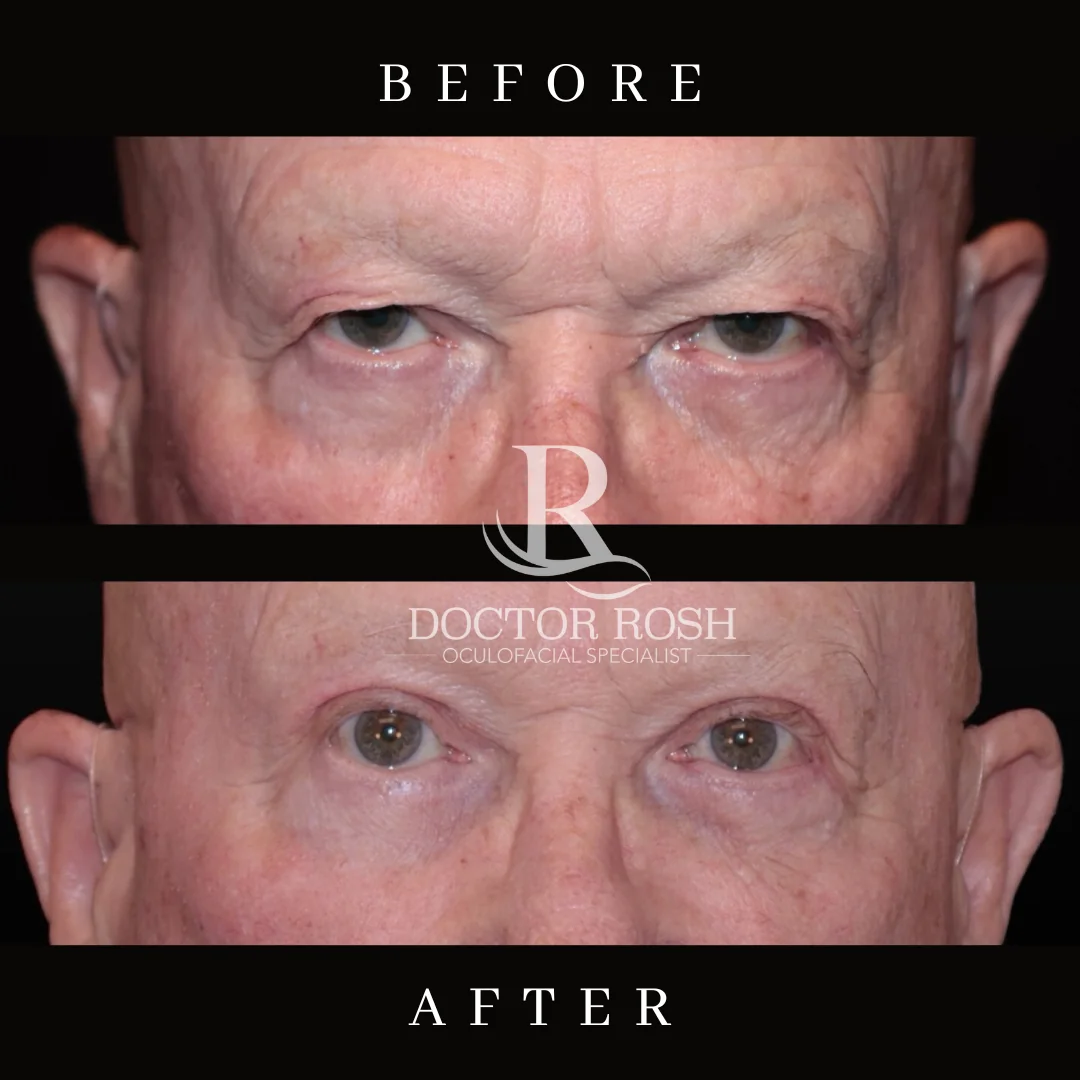 Upper blepharoplasty before and after - Kennedy eye detail 2
