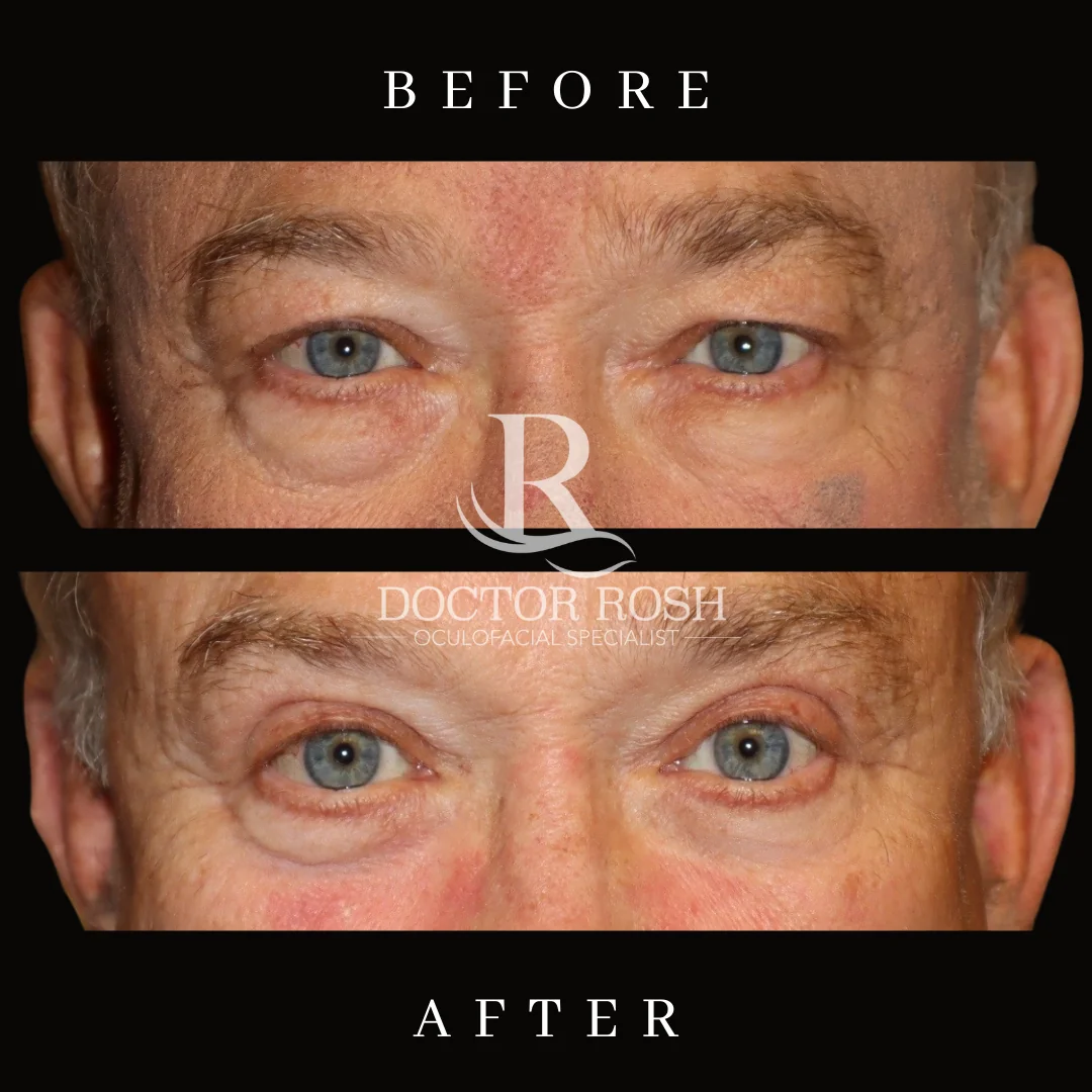 Upper blepharoplasty before and after - Leonard