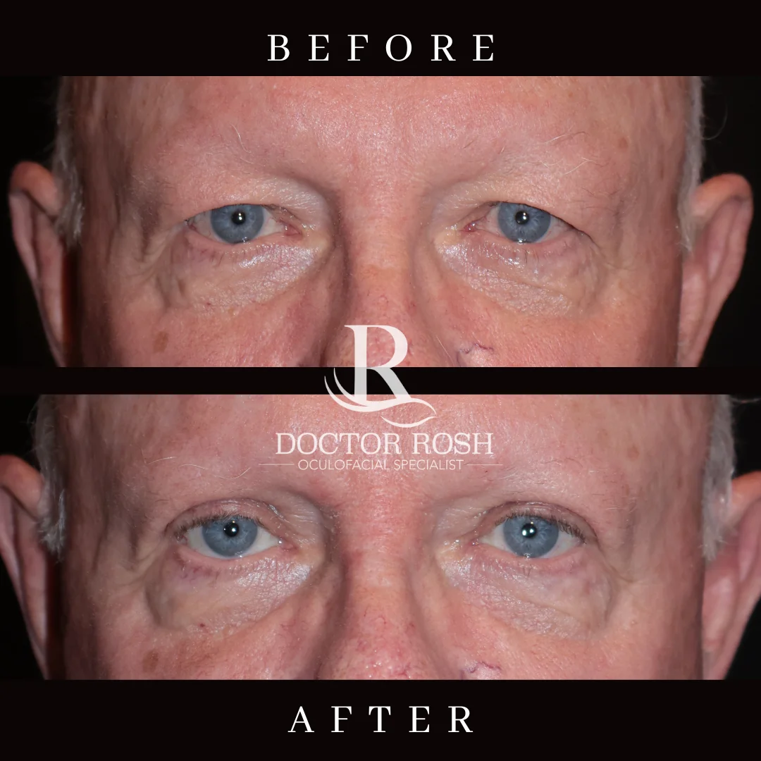Upper blepharoplasty before and after - Patient 1