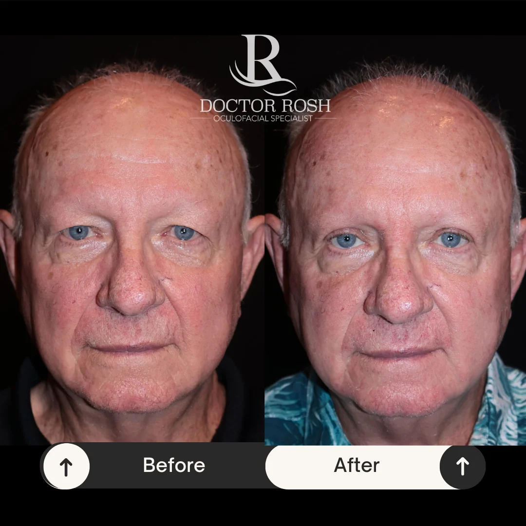 Upper blepharoplasty before and after - Patient 6