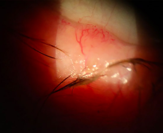 Eyelid Basal Cell Cancer