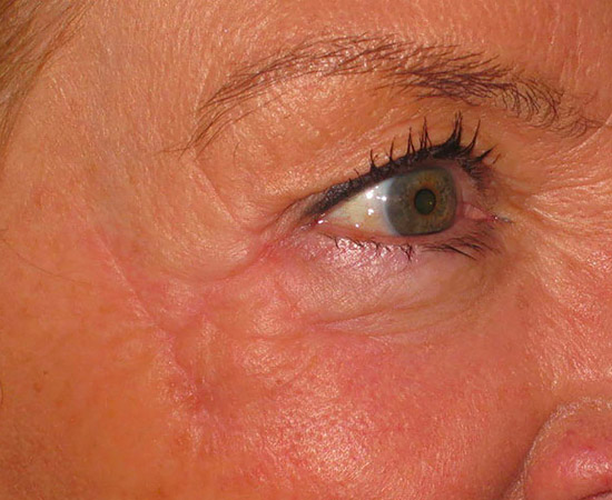 Eyelid Cancer Reconstruction