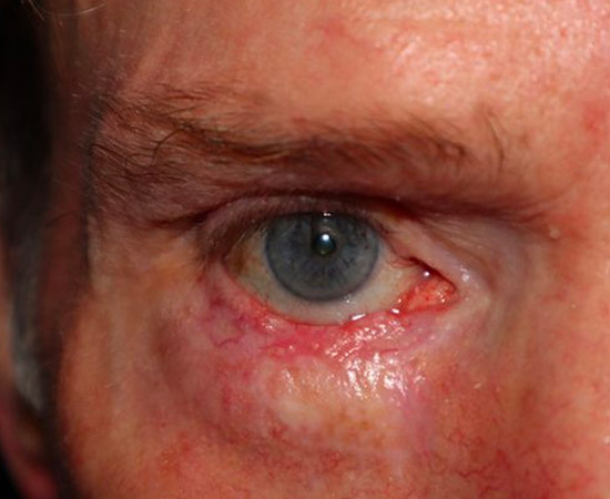 Eyelid Cancer