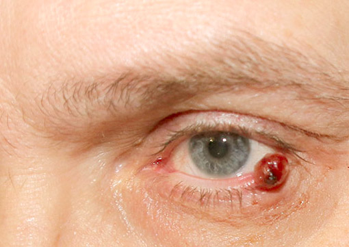 Eyelid Tumor